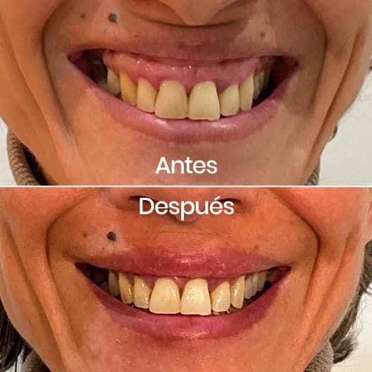 Sonrisa gingival antes y después - Resultado 1 - Holaglow