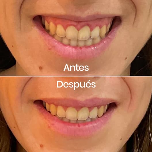 Sonrisa gingival antes y después - Resultado 2 - Holaglow