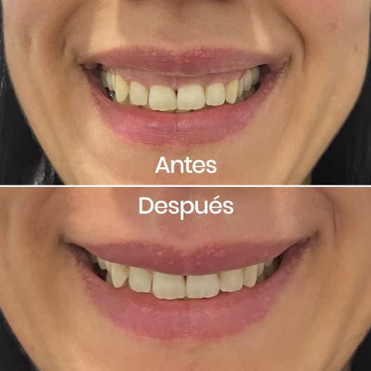 Sonrisa gingival antes y después - Resultado 3 - Holaglow