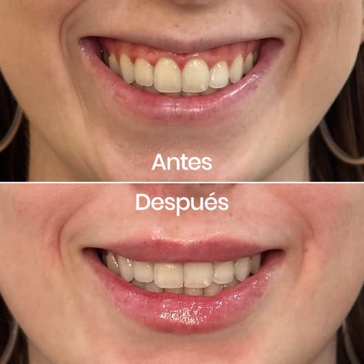 Sonrisa gingival antes y después - Resultado 4 - Holaglow