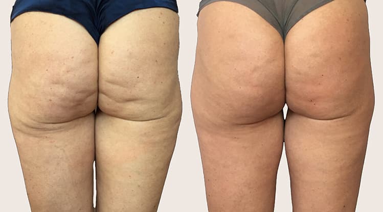 Alidya Anticelulítico antes y después - Resultado 1 - Holaglow