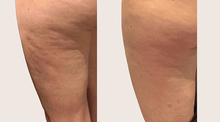 Alidya Anticelulítico antes y después - Resultado 4 - Holaglow