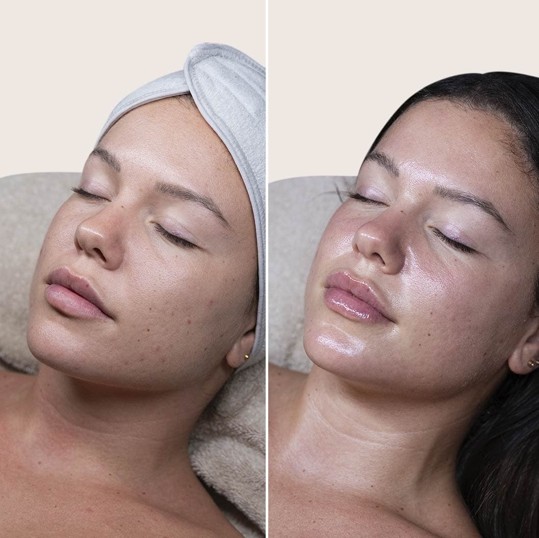 Peeling PRX antes y después - Resultado 1 - Holaglow