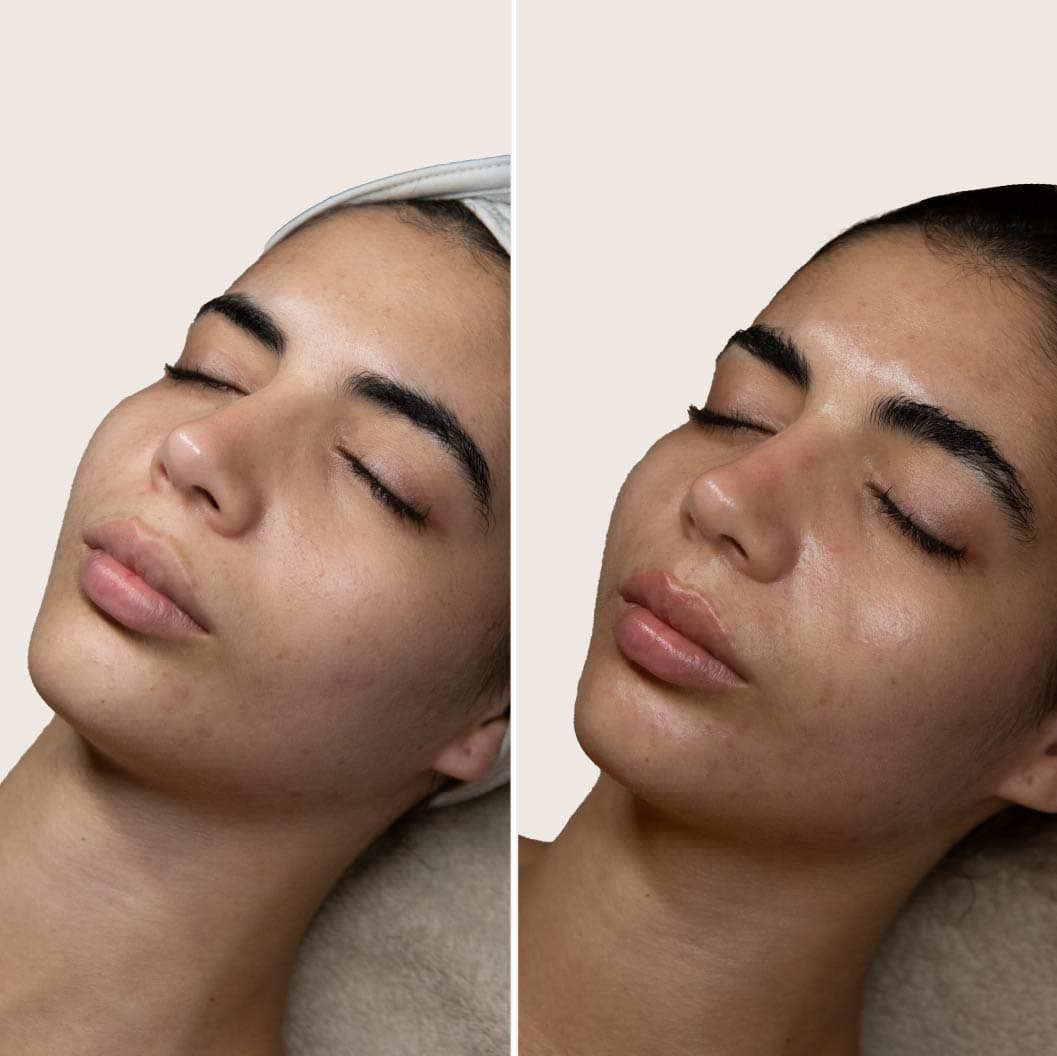 Peeling PRX antes y después - Resultado 2 - Holaglow