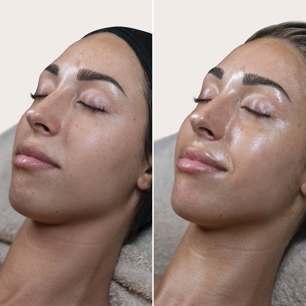 Peeling PRX antes y después - Resultado 3 - Holaglow