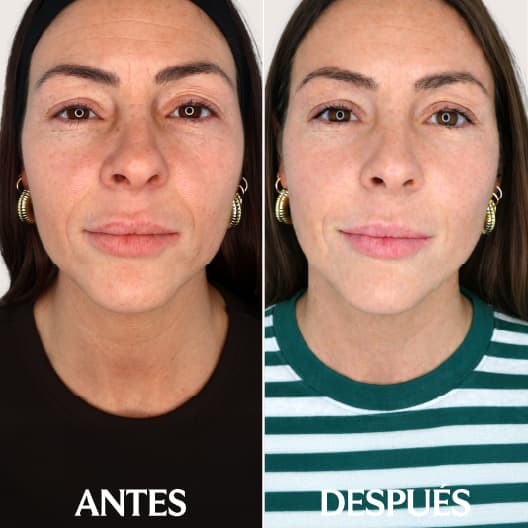 IPL Acné antes y después - Resultado 1 - Holaglow