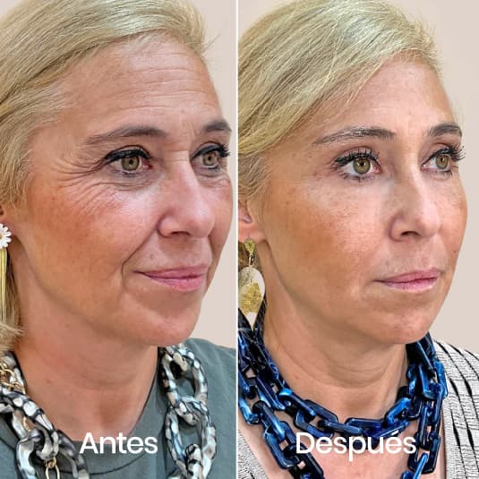 Full Face antes y después - Resultado 1 - Holaglow