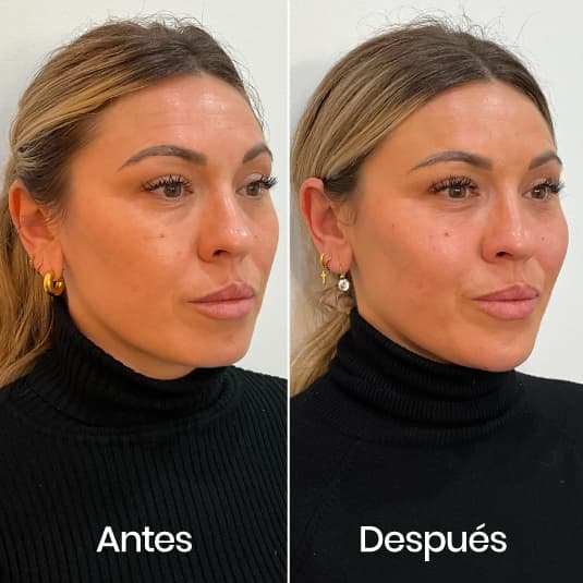 Full Face antes y después - Resultado 2 - Holaglow