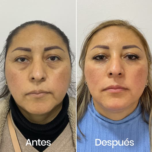 Full Face antes y después - Resultado 3 - Holaglow