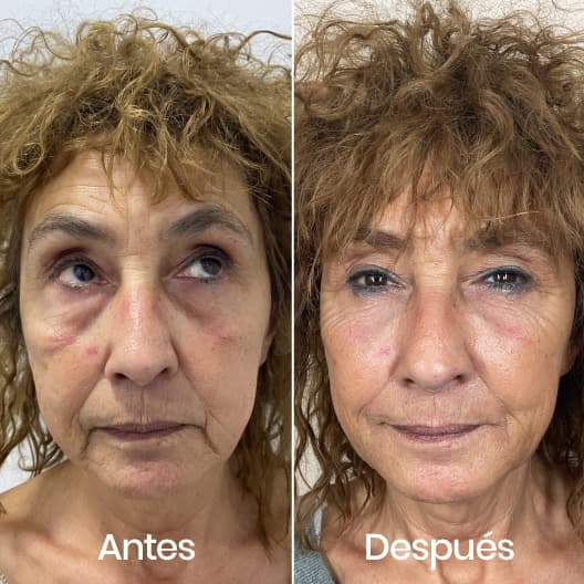 Full Face antes y después - Resultado 4 - Holaglow