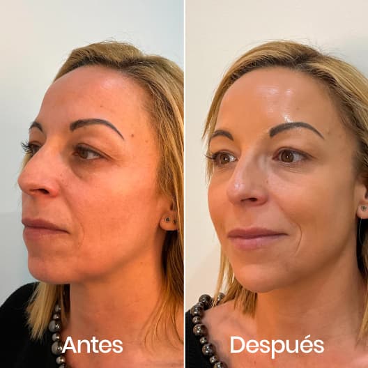 Full Face antes y después - Resultado 5 - Holaglow