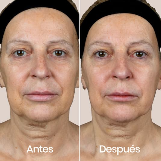 Polinucleotidos antes y después - Resultado 1 - Holaglow