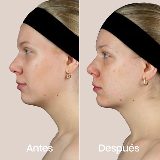 Polinucleotidos antes y después - Resultado 2 - Holaglow