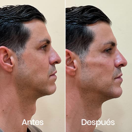 Marcación mandibular antes y después - Resultado 1 - Holaglow