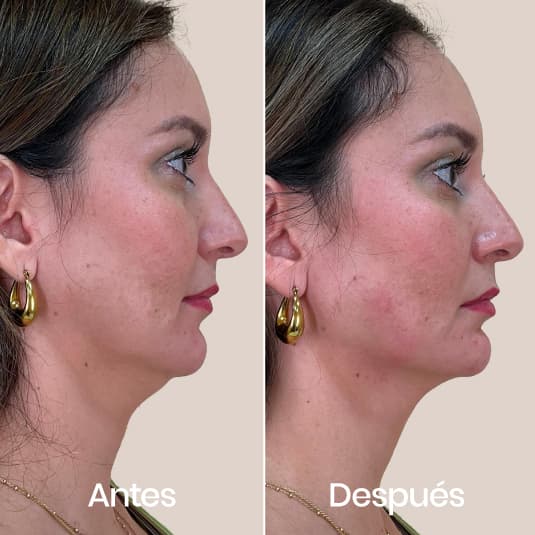Marcación mandibular antes y después - Resultado 2 - Holaglow