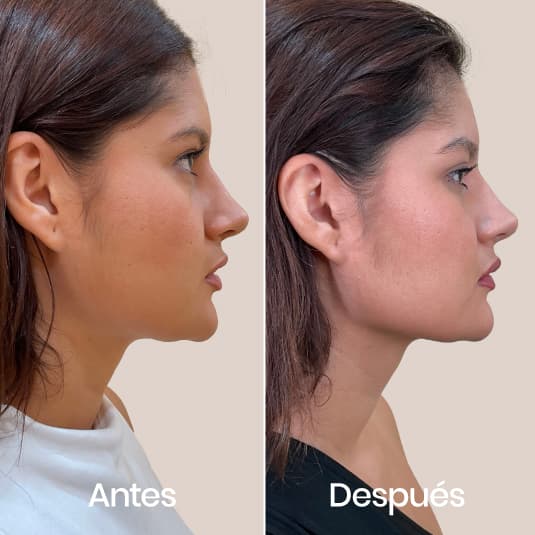 Marcación mandibular antes y después - Resultado 3 - Holaglow