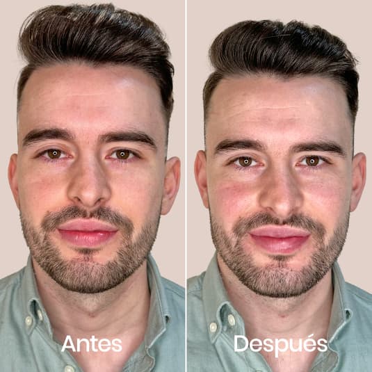 Marcación mandibular antes y después - Resultado 4 - Holaglow