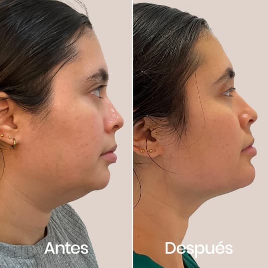 Marcación mandibular antes y después - Resultado 5 - Holaglow