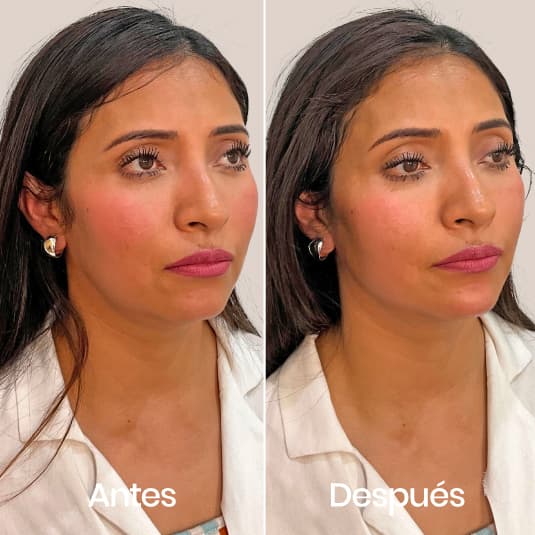 Marcación mandibular antes y después - Resultado 6 - Holaglow