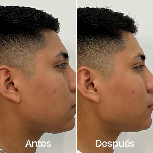 Marcación mandibular antes y después - Resultado 7 - Holaglow