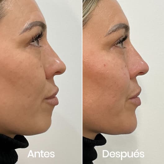 Proyección de mentón antes y después - Resultado 1 - Holaglow
