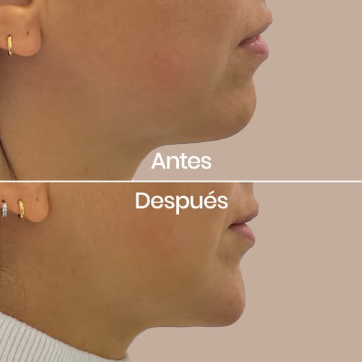 Proyección de mentón antes y después - Resultado 2 - Holaglow