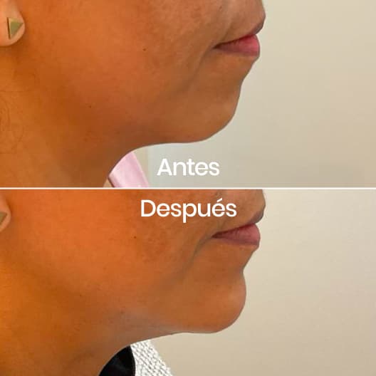 Proyección de mentón antes y después - Resultado 3 - Holaglow