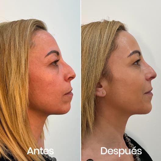 Proyección de mentón antes y después - Resultado 4 - Holaglow