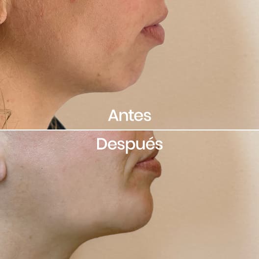 Proyección de mentón antes y después - Resultado 5 - Holaglow