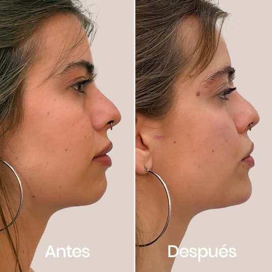 Proyección de mentón antes y después - Resultado 7 - Holaglow