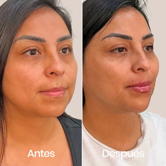 Proyección de mentón antes y después - Resultado 8 - Holaglow