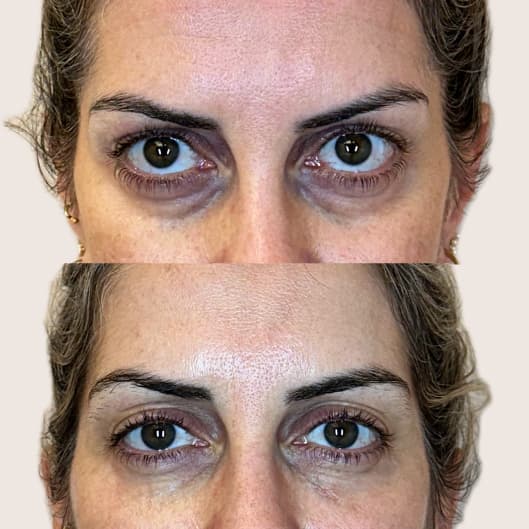 Relleno de ojeras antes y después - Resultado 12 - Holaglow