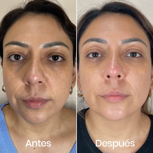 Relleno de ojeras antes y después - Resultado 1 - Holaglow