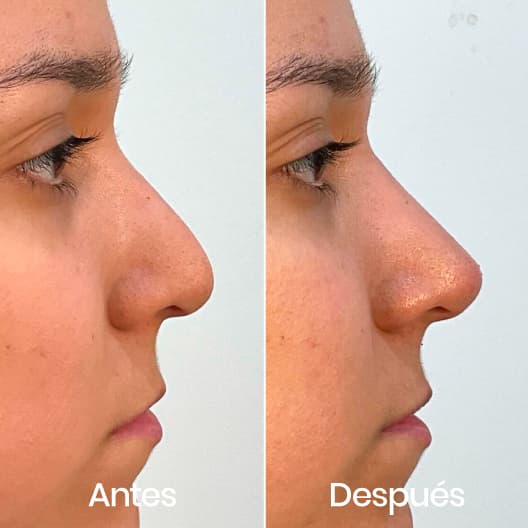 Rinomodelación antes y después - Resultado 6 - Holaglow